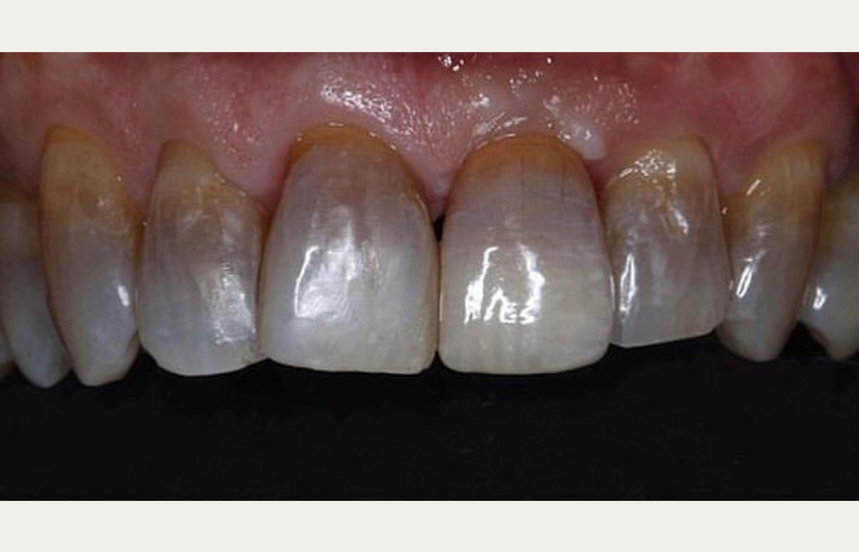 After - Brigstock Dental