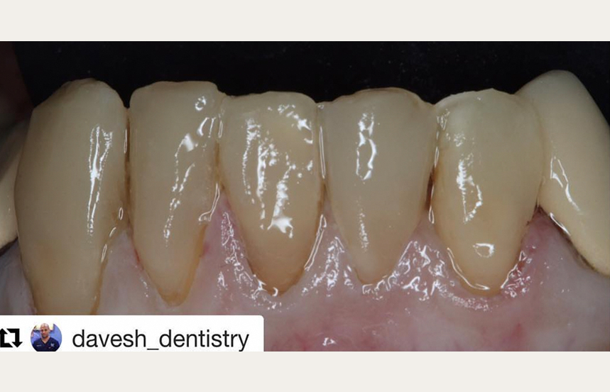 After - Brigstock Dental