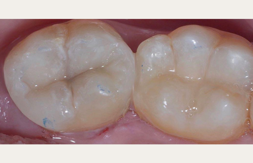 After - Brigstock Dental