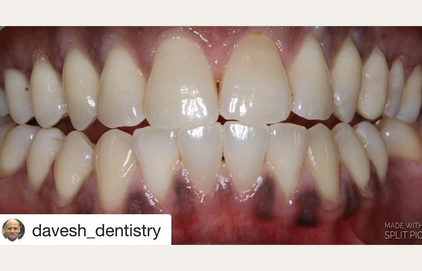 After - Brigstock Dental