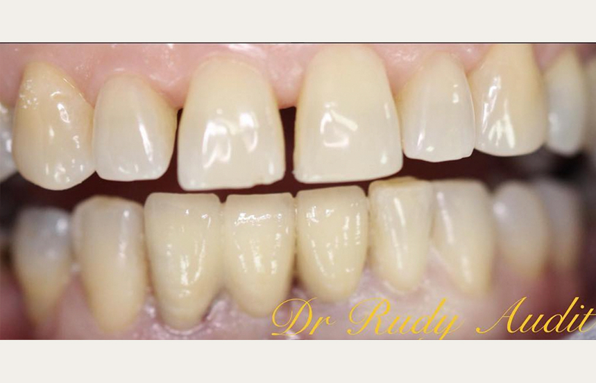 After - Brigstock Dental