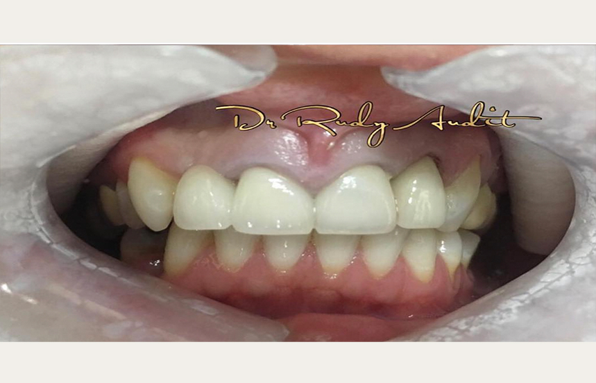 After - Brigstock Dental