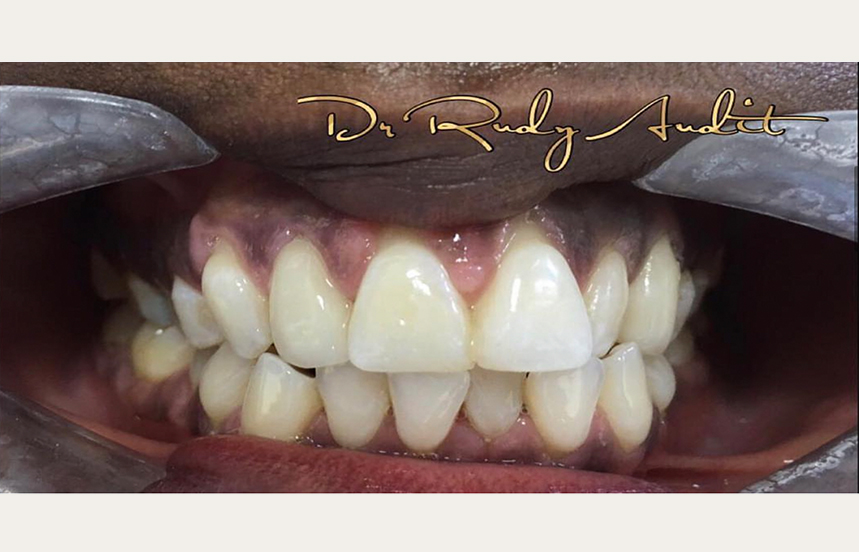 After - Brigstock Dental