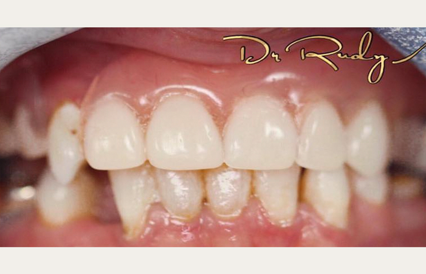 After - Brigstock Dental