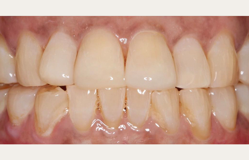 After - Brigstock Dental