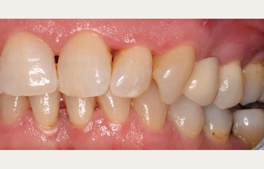 After - Brigstock Dental