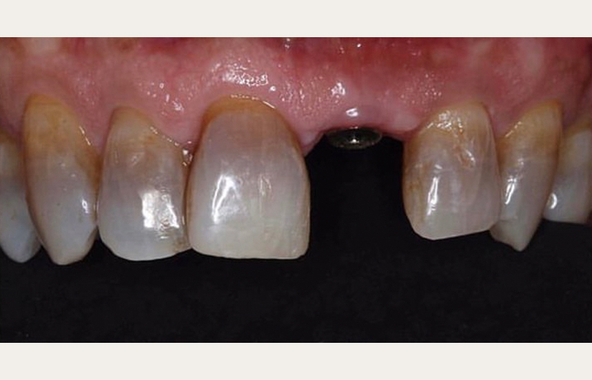 Before - Brigstock Dental