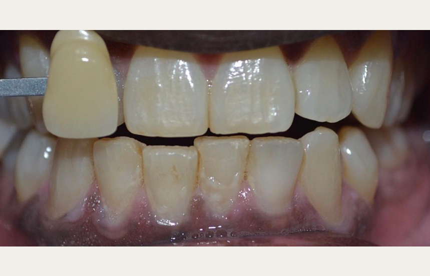 Before - Brigstock Dental