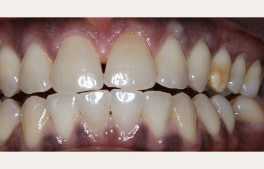 Before - Brigstock Dental