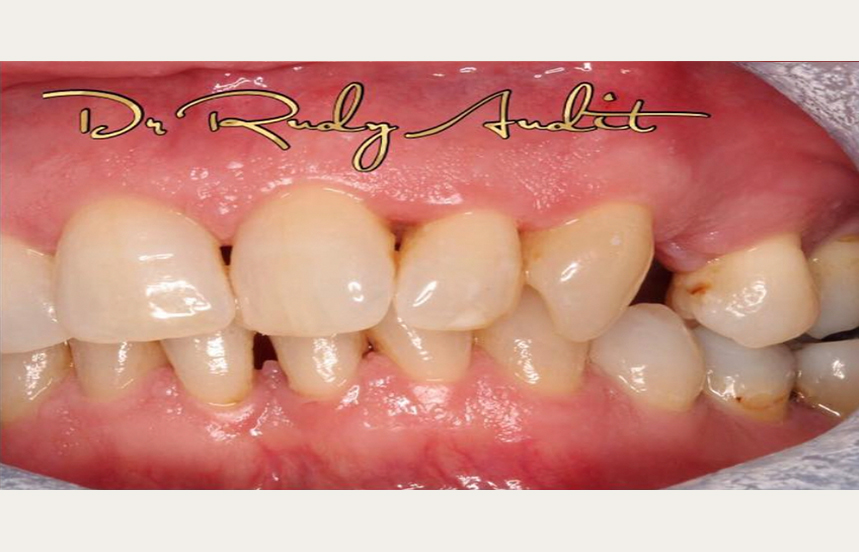 Before - Brigstock Dental