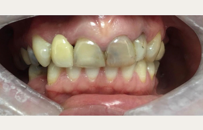 Before - Brigstock Dental