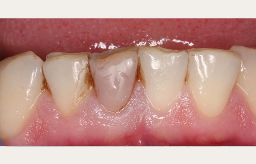 Before - Brigstock Dental