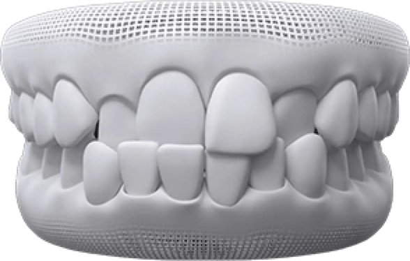 invisalign before after