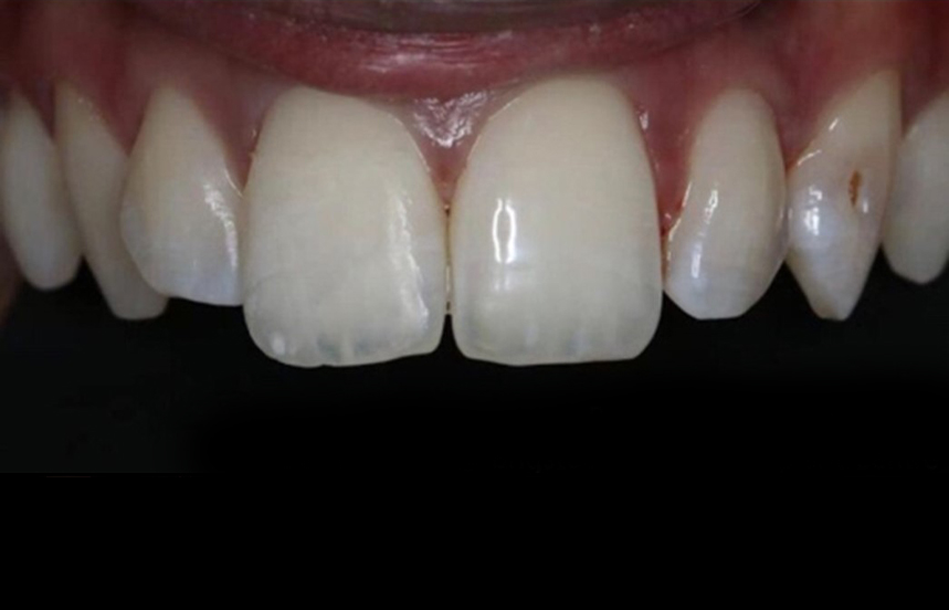 After - Brigstock Dental