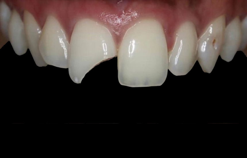 Before - Brigstock Dental