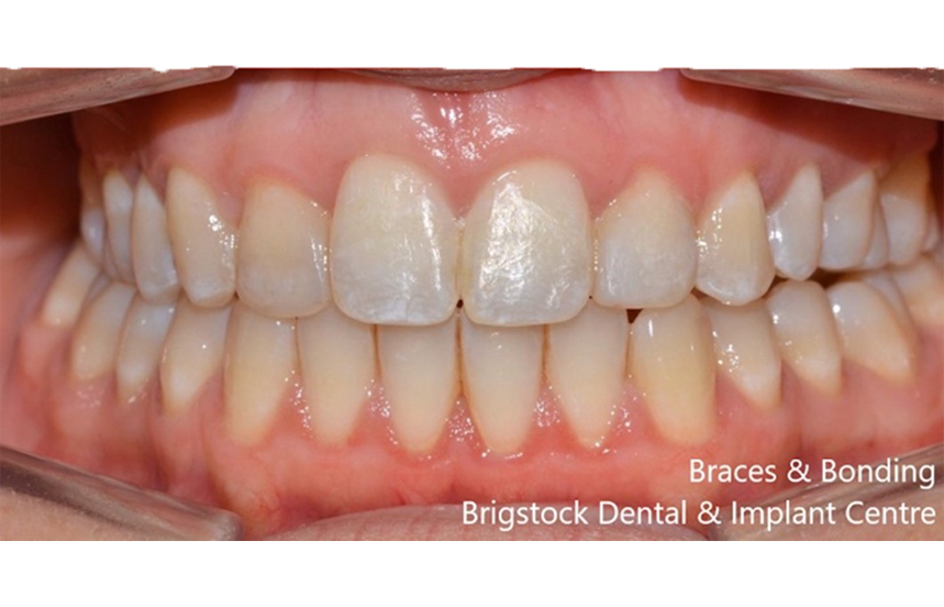 After - Brigstock Dental