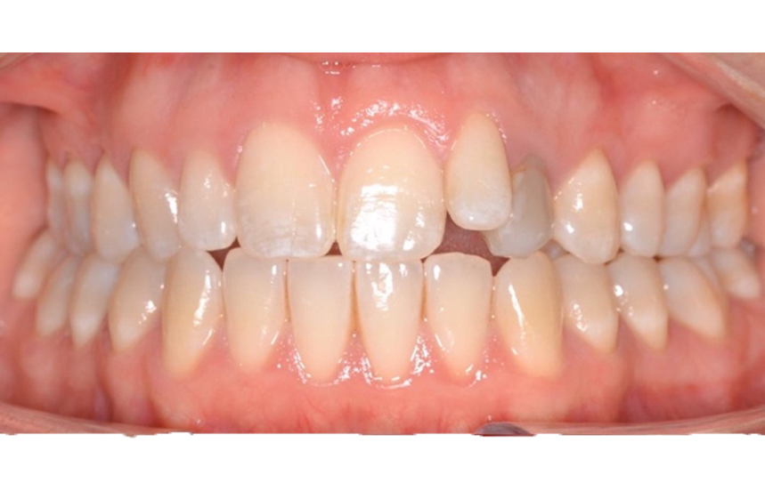 Before - Brigstock Dental