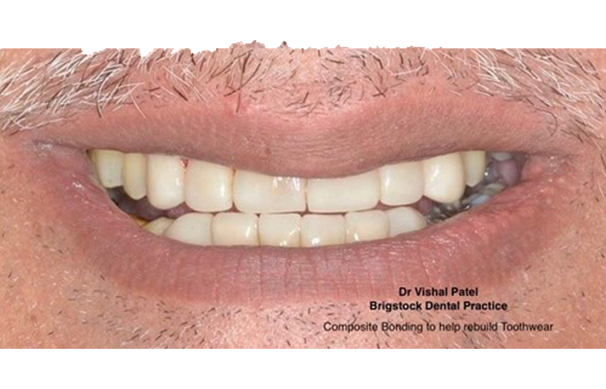 After - Brigstock Dental