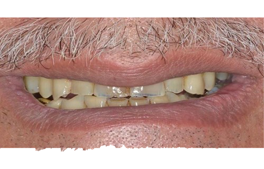 Before - Brigstock Dental