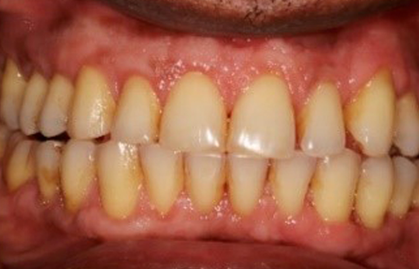 After - Brigstock Dental