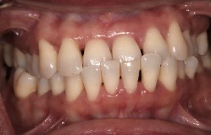 After - Brigstock Dental