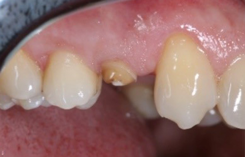 Before - Brigstock Dental